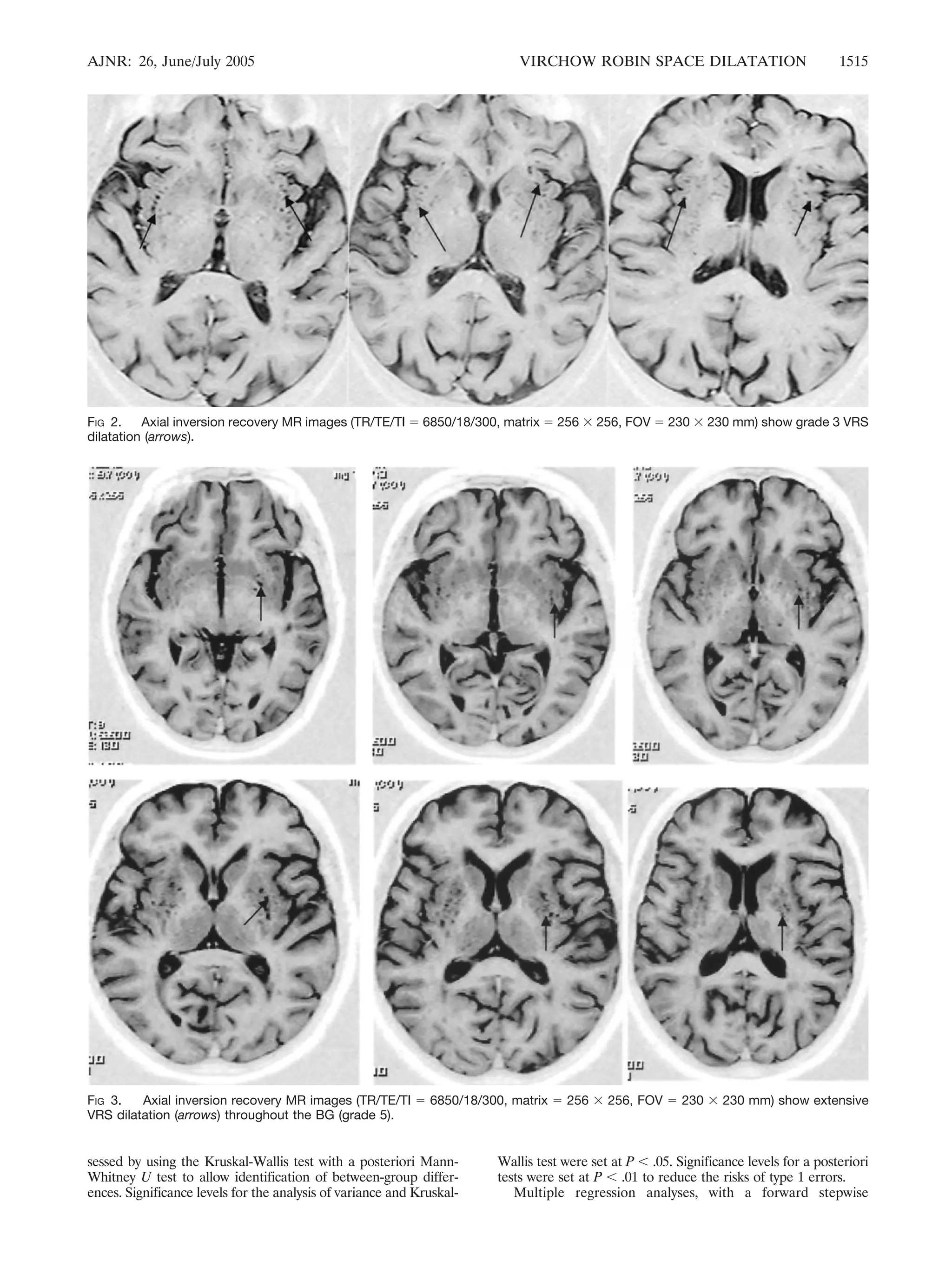 AJNR: 26, June/July 2005 VIRCHOW ROBIN SPACE DILATATION 1515 
FIG 2. Axial inversion recovery MR images (TR/TE/TI  6850/18/300, matrix  256  256, FOV  230  230 mm) show grade 3 VRS 
dilatation (arrows). 
FIG 3. Axial inversion recovery MR images (TR/TE/TI  6850/18/300, matrix  256  256, FOV  230  230 mm) show extensive 
VRS dilatation (arrows) throughout the BG (grade 5). 
sessed by using the Kruskal-Wallis test with a posteriori Mann- 
Whitney U test to allow identification of between-group differ-ences. 
Significance levels for the analysis of variance and Kruskal- 
Wallis test were set at P  .05. Significance levels for a posteriori 
tests were set at P  .01 to reduce the risks of type 1 errors. 
Multiple regression analyses, with a forward stepwise 
 