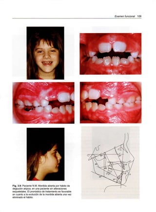 Examen funcional 109
Fig. 3.9: Paciente N.M. Mordida abierta por hábito de
deglución atípica, en una paciente sin alteraciones
esqueletales. El pronóstico de tratamiento es favorable
en cuanto a la evolución de la mordida abierta una vez
eliminado el hábito.
 