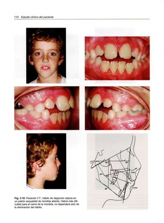 110 Estudio clínico del paciente
Fig. 3.10: Paciente V.T., hábito de deglución atípica en
un patrón esqueletal de mordida abierta. Habrá más difi-
cultad para el cierre de la mordida, no dependerá sólo de
la eliminación del hábito.
 