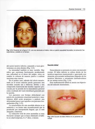 Examen funcional 113
Fig. 3.13:Paciente de la figura 3.12, una vez eliminado el hábito. Ante un patrón esqueletal favorable, la corrección fue
espontánea y estable en el tiempo.
del sector incisivo inferior, causando a veces giro-
versiones en estos dientes (Fig.3.12).
La intensidad también es muy variable. Hay
niños que succionan fuertemente produciendo
una callosidad en el dorso del pulgar, otros en
cambio lo colocan de manera pasiva o realizan
succiones muy suaves.
En el primer caso, además del efecto mencio-
nado en el sector anterior puede generarse una
mordida cruzada uni o bilateral, debida a una
compresión transversal del maxilar superior pro-
vocada por la presión de la musculatura perioral
como resultado del vacío intrabucal generado por
la succión.
Los pacientes con biotipo dolicofacial con
patrón de crecimiento rotacional posterior y mus-
culatura débil serán propensos a padecer una
deformidad mayor que aquellos con patrones bra-
quifaciales (Fig.3.12).
La característica de esta mordida abierta es su
asimetría y su forma más circunferencial que la
producida por interposición lingual, que es más
alargada y simétrica.
La reducción total de estas anomalías es muy
frecuente siempre que se haya eliminado el hábi-
to en edad temprana, 6 o 7 años, o menos.
Succión labial
Generalmente se presenta en casos con marcado
overjet. El labio inferior se coloca detrás de los
incisivos superiores manteniendo o agravando esta
situación, provocando inclinaciones linguales de los
incisivos inferiores o retrusiones dentoalveolares
de ese mismo sector (Fig.3.14).
Esta malformación labial se asocia con hiperto-
nía del músculo mentoniano.
Fig. 3.14:Succión de labio inferior en un paciente con
overjet
 