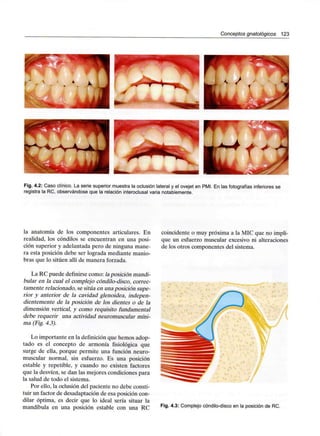 Conceptos gnatológicos 123
Fig. 4.2: Caso clínico. La serie superior muestra la oclusión lateral y el ovejet en PMI. En las fotografías inferiores se
registra la RC, observándose que la relación interoclusal varia notablemente.
la anatomía de los componentes articulares. En
realidad, los cóndilos se encuentran en una posi-
ción superior y adelantada pero de ninguna mane-
ra esta posición debe ser lograda mediante manio-
bras que lo sitúen allí de manera forzada.
La RC puede definirse como: ¡a posición mandi-
bular en la cual el complejo cóndilo-disco, correc-
tamente relacionado, se sitúa en unaposición supe-
rior y anterior de la cavidad glenoidea, indepen-
dientemente de la posición de los dientes o de la
dimensión vertical, y como requisito fundamental
debe requerir una actividad neuromuscular míni-
ma (Fig.4.3).
Lo importante en la definición que hemos adop-
tado es el concepto de armonía fisiológica que
surge de ella, porque permite una función neuro-
muscular normal, sin esfuerzo. Es una posición
estable y repetible, y cuando no existen factores
que la desvíen, se dan las mejores condiciones para
la salud de todo el sistema.
Por ello, la oclusión del paciente no debe consti-
tuir un factor de desadaptación de esa posición con-
dilar óptima, es decir que lo ideal sería situar la
mandíbula en una posición estable con una RC
coincidente o muy próxima a la MIC que no impli-
que un esfuerzo muscular excesivo ni alteraciones
de los otros componentes del sistema.
Fig. 4.3: Complejo cóndilo-disco en la posición de RC.
 