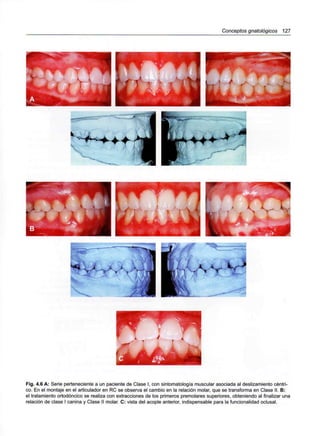 Conceptos gnatológicos 127
. 4.6 A: Serie perteneciente a un paciente de Clase I, con sintomatología muscular asociada al deslizamiento cén
co. En el montaje en el articulador en RC se observa el cambio en la relación molar, que se transforma en Clase II. B:
el tratamiento ortodóncico se realiza con extracciones de los primeros premolares superiores, obteniendo al finalizar una
relación de clase I canina y Clase II molar. C: vista del acople anterior, indispensable para la funcionalidad oclusal.
 