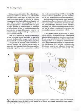 128 Estudio gnatológico
En nuestro ejercicio clínico el abordaje del pro-
blema oclusal debe ser distinto al del rehabilitador
y debemos tener como punto de partida para nues-
tra rehabilitación oclusal, el abordaje de ese pro-
blema desde atrás hacia adelante, trabajando pri-
mero el factor vertical del sector posterior. Es una
metodología opuesta a la de un rehabilitador, pero
persigue el mismo fin. Esta diferencia en el aborda-
je del problema se basa en las limitaciones de los
movimientos verticales del segmento posterior y la
posibilidad de la compensación que podemos hacer
en el segmento anterior.
En el sector posterior se realizarán modificacio-
nes del torque que afectan la posición vertical de las
cúspides fundamentales (torque negativo) para la
disminución de los contactos prematuros (Fig. 4.7).
La capacidad de intrusión a nivel de molares es
bastante limitada con técnicas convencionales, sí
aumentan con la aplicación de fuerzas aplicadas a
un anclaje esqueletal como son los microtornillos y
ésta puede ser una de las posibilidades para poder
eliminar contactos prematuros que sean responsa-
bles de una inestabilidad ortopédica mandibular
Movimientos en sentido sagital como la mesiali-
zación de los molares, o bien en sentido transversal
como la expansión o contracción de la arcada supe-
rior, pueden mejorar la relación oclusal posterior,
aceptando, por último, la posibilidad de realizar al-
gún tipo de tallado o remodelación coronaria que
permita finalmente el asentamiento oclusal.
Es una práctica común en ortodoncia, la utiliza-
ción de elásticos intermaxilares para conseguir un
adecuado entrecruzamiento anterior, reconociendo
de esta manera, las limitaciones del control del seg-
mento posterior. Si no se logra el overbite necesa-
rio es porque existe un obstáculo en el sector poste-
rior que impide el cierre anterior. Las limitaciones
del control posterior nos inducen a "compensar"
con movimientos de extrusión anterior. Esta com-
B
Fig 4.7 A: El inadecuado torque de los molares (torque positivo) provoca un problema vertical que se traduce en insufi-
ciente overtbite. B: Cuando se realiza el torque negativo de los molares, se produce el asentamientooclusal posterior
con el consiguiente aumento del overbite.
 