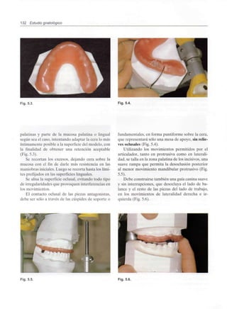 132 Estudio gnatológico
Fig. 5.3. Fig. 5.4.
palatinas y parte de la mucosa palatina o lingual
según sea el caso, intentando adaptar la cera lo más
íntimamente posible a la superficie del modelo, con
la finalidad de obtener una retención aceptable
(Fig. 5.3).
Se recortan los excesos, dejando cera sobre la
mucosa con el fin de darle más resistencia en las
maniobras iniciales. Luego se recorta hasta los lími-
tes prefijados en las superficies linguales.
Se alisa la superficie oclusal, evitando todo tipo
de irregularidades que provoquen interferencias en
los movimientos.
El contacto oclusal de las piezas antagonistas,
debe ser sólo a través de las cúspides de soporte o
fundamentales, en forma puntiforme sobre la cera,
que representará sólo una mesa de apoyo, sinrelie-
ves oclusales (Fig. 5.4).
Utilizando los movimientos permitidos por el
articulador, tanto en protrusiva como en laterali-
dad, se talla en la zona palatina de los incisivos, una
suave rampa que permita la desoclusión posterior
al menor movimiento mandibular protrusivo (Fig.
5.5).
Debe construirse también una guía canina suave
y sin interrupciones, que desocluya el lado de ba-
lance y el resto de las piezas del lado de trabajo,
en los movimientos de lateralidad derecha e iz-
quierda (Fig. 5.6).
Fig. 5.5. Fig. 5.6.
 