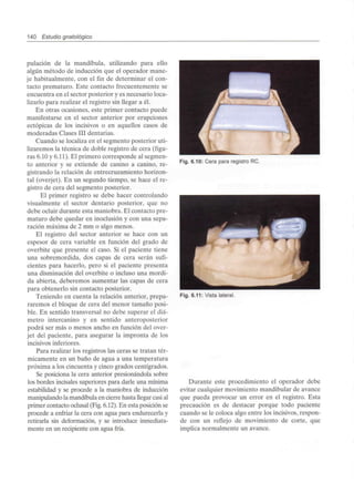 140 Estudio gnatológico
pulación de la mandíbula, utilizando para ello
algún método de inducción que el operador mane-
je habitualmente, con el fin de determinar el con-
tacto prematuro. Este contacto frecuentemente se
encuentra en el sector posterior y es necesario loca-
lizarlo para realizar el registro sin llegar a él.
En otras ocasiones, este primer contacto puede
manifestarse en el sector anterior por erupciones
ectópicas de los incisivos o en aquellos casos de
moderadas Clases III dentarias.
Cuando se localiza en el segmento posterior uti-
lizaremos la técnica de doble registro de cera (figu-
ras 6.10 y 6.11). El primero corresponde al segmen-
to anterior y se extiende de canino a canino, re-
gistrando la relación de entrecruzamiento horizon-
tal (overjet). En un segundo tiempo, se hace el re-
gistro de cera del segmento posterior.
El primer registro se debe hacer controlando
visualmente el sector dentario posterior, que no
debe ocluir durante esta maniobra. El contacto pre-
maturo debe quedar en inoclusión y con una sepa-
ración máxima de 2 mm o algo menos.
El registro del sector anterior se hace con un
espesor de cera variable en función del grado de
overbite que presente el caso. Si el paciente tiene
una sobremordida, dos capas de cera serán sufi-
cientes para hacerlo, pero si el paciente presenta
una disminución del overbite o incluso una mordi-
da abierta, deberemos aumentar las capas de cera
para obtenerlo sin contacto posterior.
Teniendo en cuenta la relación anterior, prepa-
raremos el bloque de cera del menor tamaño posi-
ble. En sentido transversal no debe superar el diá-
metro intercanino y en sentido anteroposterior
podrá ser más o menos ancho en función del over-
jet del paciente, para asegurar la impronta de los
incisivos inferiores.
Para realizar los registros las ceras se tratan tér-
micamente en un baño de agua a una temperatura
próxima a los cincuenta y cinco grados centígrados.
Se posiciona la cera anterior presionándola sobre
los bordes incisales superiores para darle una mínima
estabilidad y se procede a la maniobra de inducción
manipulando la mandíbulaen cierre hasta llegar casial
primer contacto oclusal (Fig. 6.12). En esta posición se
procede a enfriar la cera con agua para endurecerla y
retirarla sin deformación, y se introduce inmediata-
mente en un recipiente con agua fría.
Fig. 6.10: Cera para registro RC.
Fig. 6.11: Vista lateral.
Durante este procedimiento el operador debe
evitar cualquier movimiento mandibular de avance
que pueda provocar un error en el registro. Esta
precaución es de destacar porque todo paciente
cuando se le coloca algo entre los incisivos, respon-
de con un reflejo de movimiento de corte, que
implica normalmente un avance.
 