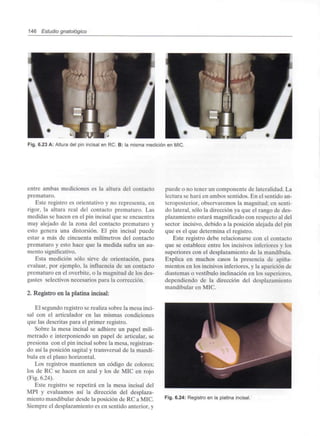 146 Estudio gnatológico
Fig. 6.23 A: Altura del pin incisal en RC. B: la misma medición en MIC.
entre ambas mediciones es la altura del contacto
prematuro.
Este registro es orientativo y no representa, en
rigor, la altura real del contacto prematuro. Las
medidas se hacen en el pin incisal que se encuentra
muy alejado de la zona del contacto prematuro y
esto genera una distorsión. El pin incisal puede
estar a más de cincuenta milímetros del contacto
prematuro y esto hace que la medida sufra un au-
mentosignificativo.
Esta medición sólo sirve de orientación, para
evaluar, por ejemplo, la influencia de un contacto
prematuro en el overbite, o la magnitud de los des-
gastes selectivos necesarios para la corrección.
2. Registro en la platina incisal:
El segundo registro se realiza sobre la mesa inci-
sal con el articulador en las mismas condiciones
que las descritas para el primer registro.
Sobre la mesa incisal se adhiere un papel mili-
metrado e interponiendo un papel de articular, se
presiona con el pin incisal sobre la mesa, registran-
do así la posición sagital y transversal de la mandí-
bula en el plano horizontal.
Los registros mantienen un código de colores;
los de RC se hacen en azul y los de MIC en rojo
(Fig. 6.24).
Este registro se repetirá en la mesa incisal del
MPI y evaluamos así la dirección del desplaza-
miento mandibular desde la posición de RC a MIC.
Siempre el desplazamiento es en sentido anterior, y
puede o no tener un componente de lateralidad.La
lectura se hará en ambos sentidos. En el sentido an-
teroposterior, observaremos la magnitud; en senti-
do lateral, sólo la dirección ya que el rango de des-
plazamiento estará magnificadocon respecto al del
sector incisivo, debido a la posición alejada del pin
que es el que determina el registro.
Este registro debe relacionarse con el contacto
que se establece entre los incisivos inferiores y los
superiores con el desplazamiento de la mandíbula.
Explica en muchos casos la presencia de apiña-
mientos en los incisivos inferiores, y la aparición de
diastemas o vestíbulo inclinación en los superiores,
dependiendo de la dirección del desplazamiento
mandibular en MIC.
Fig. 6.24: Registro en la platina incisal.
 