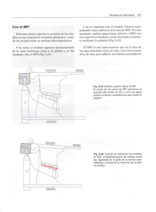 Montaje en articulador 147
Con el MPI
Debemos ahora registrar la posición de los cón-
dilos en sus respectivas cavidades glenoideas, cuan-
do las arcadas están en máxima intercuspidación.
• Se retira el modelo superior desmontándolo
de la rama homologa junto a su platina y se fija
mediante ella al MPI (Fig. 6.25).
• Se lo relaciona con el modelo inferior inter-
poniendo entre ambos la cera rosa de MIC. En este
momento, ambas ramas (rama inferior y MPI) con
sus respectivos modelos, están vinculadas solamen-
te mediante la oclusión (Fig. 6.26).
El MPI es una rama superior que en la zona de
las cajas articulares tiene un cubo, cuya cara externa
sirve de base para adherir una lámina autoadhesiva
Fig. 6.25: Modelo superior fijado al MPI.
El centro de los cubos de MPI reproduce la
posición del cóndilo en RC, y con una aguja
perfora la lámina autoadhesiva para hacer el
registro.
Fig. 6.26: Cuando se relacionan los modelos
en MIC, el desplazamiento del cóndilo podrá
ser registrado en la grilla de la lámina auto-
adhesiva, a través de la impronta de la esfe-
ra condilar.
 