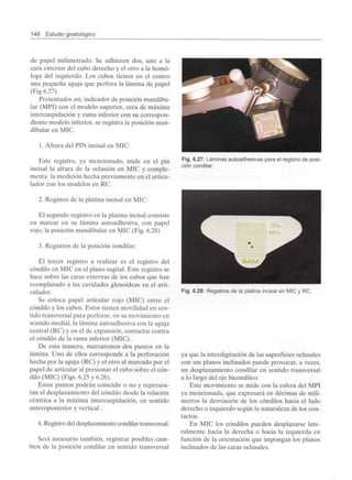 148 Estudio gnatológico
de papel milimetrado. Se adhieren dos, uno a la
cara exterior del cubo derecho y el otro a la homo-
loga del izquierdo. Los cubos tienen en el centro
una pequeña aguja que perfora la lámina de papel
(Fig 6.27).
Presentados así, indicador de posición mandibu-
lar (MPI) con el modelo superior, cera de máxima
intercuspidación y rama inferior con su correspon-
diente modelo inferior, se registra la posición man-
dibular en MIC.
1. Altura del PIN incisal en MIC:
Este registro, ya mencionado, mide en el pin
incisal la altura de la oclusión en MIC y comple-
menta la medición hecha previamente en el articu-
lador con los modelos en RC.
2. Registro de la platina incisal en MIC:
El segundo registro en la platina incisal consiste
en marcar en su lámina autoadhesiva, con papel
rojo, la posición mandibular en MIC (Fig. 6.28)
3. Registros de la posición condilar:
El tercer registro a realizar es el registro del
cóndilo en MIC en el plano sagital. Este registro se
hace sobre las caras externas de los cubos que han
reemplazado a las cavidades glenoideas en el arti-
culador.
Se coloca papel articular rojo (MIC) entre el
cóndilo y los cubos. Estos tienen movilidad en sen-
tido transversal para perforar, en su movimiento en
sentido medial, la lámina autoadhesiva con la aguja
central (RC) y en el de expansión, contactar contra
el cóndilo de la rama inferior (MIC) .
De esta manera, marcaremos dos puntos en la
lámina. Uno de ellos corresponde a la perforación
hecha por la aguja (RC) y el otro al marcado por el
papel de articular al presionar el cubo sobre el cón-
dilo (MIC) (Figs. 6.25 y 6.26).
Estos puntos podrán coincidir o no y represen-
tan el desplazamiento del cóndilo desde la relación
céntrica a la máxima intercuspidación, en sentido
anteroposterior y vertical.
4. Registro del desplazamiento condilar transversal:
Será necesario también, registrar posibles cam-
bios de la posición condilar en sentido transversal
Fig. 6.27: Láminas autoadhesivas para el registro de posi-
ción condilar.
Fig. 6.28: Registros de la platina incisal en MIC y RC.
ya que la interdigitación de las superficies oclusales
con sus planos inclinados puede provocar, a veces,
un desplazamiento condilar en sentido transversal
a lo largo del eje bicondileo.
Este movimiento se mide con la esfera del MPI
ya mencionada, que expresará en décimas de milí-
metros la desviación de los cóndilos hacia el lado
derecho o izquierdo según la naturaleza de los con-
tactos.
En MIC los cóndilos pueden desplazarse late-
ralmente hacia la derecha o hacia la izquierda en
función de la orientación que impongan los planos
inclinados de las caras oclusales.
 