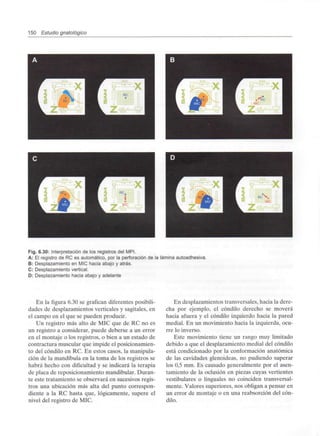 150 Estudio gnatológico
Fig. 6.30: Interpretación de los registros del MPI.
A: El registro de RC es automático, por la perforación de la láminaautoadhesiva.
B: Desplazamiento en MIC hacia abajo y atrás.
C: Desplazamiento vertical.
D: Desplazamiento hacia abajo y adelante
En la figura 6.30 se grafican diferentes posibili-
dades de desplazamientos verticales y sagitales, en
el campo en el que se pueden producir.
Un registro más alto de MIC que de RC no es
un registro a considerar, puede deberse a un error
en el montaje o los registros, o bien a un estado de
contractura muscular que impide el posicionamien-
to del cóndilo en RC. En estos casos, la manipula-
ción de la mandíbula en la toma de los registros se
habrá hecho con dificultad y se indicará la terapia
de placa de reposicionamiento mandibular. Duran-
te este tratamiento se observará en sucesivos regis-
tros una ubicación más alta del punto correspon-
diente a la RC hasta que, lógicamente, supere el
nivel del registro de MIC.
En desplazamientos transversales, hacia la dere-
cha por ejemplo, el cóndilo derecho se moverá
hacia afuera y el cóndilo izquierdo hacia la pared
medial. En un movimiento hacia la izquierda, ocu-
rre lo inverso.
Este movimiento tiene un rango muy limitado
debido a que el desplazamiento medial del cóndilo
está condicionado por la conformación anatómica
de las cavidades glenoideas, no pudiendo superar
los 0,5 mm. Es causado generalmente por el asen-
tamiento de la oclusión en piezas cuyas vertientes
vestibulares o linguales no coinciden transversal-
mente. Valores superiores, nos obligan a pensar en
un error de montaje o en una reabsorción del cón-
dilo.
 