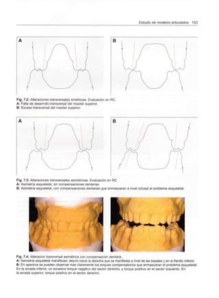 Estudio de modelos articulados 153
B
Fig. 7.2: Alteraciones transversales simétricas. Evaluación en RC.
A: Falta de desarrollo transversal del maxilar superior.
B: Exceso transversal del maxilar superior.
B
Fig. 7.3: Alteraciones transversales asimétricas. Evaluación en RC
A: Asimetría esqueletal, sin compensaciones dentarias.
B: Asimetría esqueletal, con compensaciones dentarias que enmascaran a nivel oclusal el problema esqueletal.
Fig. 7.4: Alteración transversal asimétrica con compensación dentaria.
A: Asimetría esqueletal mandibular, desvío hacia la derecha que se manifiesta a nivel de las básales y en el frenillo inferior.
B: En apertura se pueden observar más claramente los torques compensatorios que enmascaran el problema esqueletal:
En la arcada inferior, un excesivo torque negativo del sector derecho, y torque positivo en el sector izquierdo. En
la arcada superior, torque positivo en el sector derecho.
 