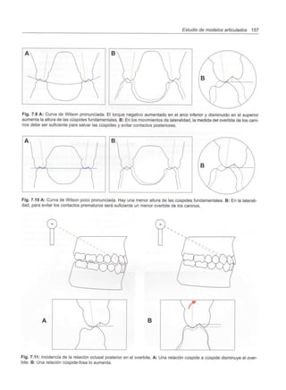 Estudio de modelos articulados 157
Fig. 7.9 A: Curva de Wilson pronunciada. El torque negativo aumentado en el arco inferior y disminuido en el superior
aumenta la altura de las cúspides fundamentales. B: En los movimientos de lateralidad, la medida del overbite de los cani-
nos debe ser suficiente para salvar las cúspides y evitar contactos posteriores.
Fig. 7.10 A: Curva de Wilson poco pronunciada. Hay una menor altura de las cúspides fundamentales. B: En la laterali-
dad, para evitar los contactos prematuros será suficiente un menor overbite de los caninos.
B
Fig. 7.11: Incidencia de la relación oclusal posterior en el overbite. A: Una relación cúspide a cúspide disminuye el over-
bite. B: Una relación cúspide-fosa lo aumenta.
 