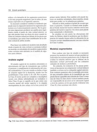 158 Estudio gnatológico
refiere a la intrusión de los segmentos posteriores
es de muy pequeña magnitud y por lo tanto, de una
escasa expresión en el segmento anterior.
Es necesario considerar también la incidencia que
puede tener la migración mesial de los segmentos pos-
teriores en el entrecruzamiento anterior. Por lo gene-
ral estas migraciones producen un cambio poco signi-
ficativo desde el punto de vista vertical anterior, ya
que sólo pueden tener un efecto de cierre cuando no
exista un contacto oclusalpor delante de laspiezas que
se mesializan, que actúa como estabilizador de la rela-
ción vertical de ambas arcadas.
Para hacer un análisis de modelos más detallado
desde el punto de vista vertical, se aconseja realizar
un montaje en articulador de modelos segmentados
como veremos más adelante en el análisis de algu-
nos casos clínicos.
Análisis sagital
El estudio sagital de los modelos articulados es
determinante del tipo de tratamiento que recibirá
el paciente y complementa la información del estu-
dio cefalométrico. Con este estudio se define el tipo
de relación sagital de la dentición, siendo tres las
posibilidades: Clase molar I, II o III. Por su parte,
la Clase II molar podrá ser completa o incompleta
siendo esta última subclasificada en verdadera o
falsa Clase II que es aquella en la que existe una
rotación mesial del molar superior y la cúspide
mesiopalatina de éste ocluye en la fosa central del
primer molar inferior. Este análisis solo puede ha-
cerse en modelos articulados observándolos desde
atrás para poder ver la oclusión por palatino.
Además se debe analizar el grado de overjet que
tiene el paciente. Cuando es normal están acopla-
dos el borde incisal del incisivo inferior con la cara
palatina del incisivo superior. En otros casos puede
estar aumentado o disminuido.
Se estudian en este punto las alteraciones del
índice de Bolton, dada la incidencia que las discre-
pancias de tamaño tienen sobre la obtención de un
correcto overjet simultáneamente con una relación
de Clase I canina.
Modelos segmentados
Para realizar este tipo de estudio es necesario
preparar los modelos de manera tal que puedan ser
removidos los sectores posteriores con el objeto de
evaluar la relación anterior que se obtiene sin la
distorsión vertical provocada por los contactos
oclusales de molares y premolares.
En oclusión, los contactos de las piezas poste-
riores al incorporar un componente verticalinducen
también a errores en la evaluación sagital anterior.
Este contacto posterior abre la mordida provocan-
do una retrusión relativa de la mandíbula que nos
puede llevar a percibir una relación de Clase I como
una de Clase II. Este efecto vertical también puede
ser responsable de un error en la valoración sagital
a nivel de caninos, en los que puede evidenciar una
Clase II o bien acentuar este efecto.
Fig. 7.12: Caso clínico. Fotografíasde la MIC, con una relación de Clase I molar y canina y overjet levementeaumentado.
 