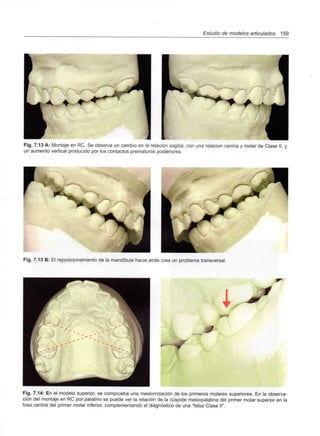 Estudio de modelos articulados 159
Fig. 7.13 A: Montaje en RC. Se observa un cambio en la relación sagital, con una relación canina y molar de Clase II, y
un aumento vertical producido por los contactos prematuros posteriores.
Fig. 7.13 B: El reposicionamiento de la mandíbula hacia atrás crea un problema transversal.
f
Fig. 7.14: En el modelo superior, se comprueba una mesiorrotación de los primeros molares superiores. En la observa-
ción del montaje en RC por palatino se puede ver la relación de la cúspide mesiopalatina del primer molar superior en la
fosa central del primer molar inferior, complementando el diagnóstico de una "falsa Clase II".
 