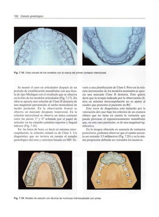 162 Estudio gnatológico
i
•
Fig. 7.18: Vista oclusal de los modelos con la marca del primer contactointeroclusal.
Se montó el caso en articulador después de un
período de estabilización mandibular con una féru-
la de tipo Michigan con el resultado que se observa
en la foto de los modelos articulados (Fig. 7.17). En
ellos se aprecia una relación de Clase II dentaria de
una magnitud aproximada al ancho mesiodistal de
medio premolar. En la observación frontal se
observa un marcado desajuste transversal. En la
relación interoclusal se observa un único contacto
entre las piezas 17 y 47 señalado por el papel de
articular en las cúspides palatina superior y lingual
inferior (Fig. 7.18).
En las fotos de boca, es decir en máxima inter-
cuspidación, la relación oclusal es de Clase I. Un
diagnóstico que no tuviera en cuenta el estudio
gnatológico del caso y estuviese basado en MIC lle-
varía a una planificación de Clase I. Pero en la rela-
ción intermaxilar de los modelos montados se apre-
cia una marcada Clase II dentaria. Esto quiere
decir que la terapia indicada por la observación clí-
nica en máxima intercuspidación no se ajusta al
cuadro que presenta el paciente en RC.
Este error de diagnóstico está inducido por la
valoración del caso bajo los criterios de un examen
clínico que no tiene en cuenta la variación que
pueda provocar el reposicionamiento mandibular
que, en este caso particular, es de una magnitudsig-
nificativa.
En la imagen obtenida en ausencia de contactos
posteriores, podemos observar que el canino necesi-
ta ser retruido 3.5 milímetros (Fig. 7.20) y en la mis-
ma proporción deberán ser retruidos los incisivos.
Fig. 7.19: Modelo de estudio con técnica de muñones individualizado con pines.
 