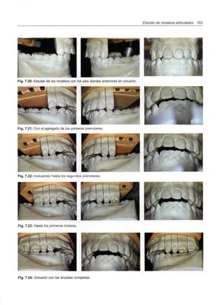 Estudio de modelos articulados 163
Fig. 7.20: Estudio de los modelos con los seis dientes anteriores en oclusión.
•EK3F
Fig. 7.21: Con el agregado de los primeros premolares.
•
Fig. 7.22: Incluyendo hasta los segundos premolares
H
Fig. 7.23: Hasta los primeros molares.
Fig. 7.24: Oclusión con las arcadas completas.
 