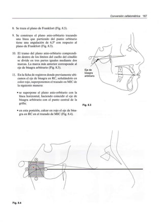 Conversión cefalométríca 167
8. Se traza el plano de Frankfort (Fig. 8.3).
9. Se construye el plano axio-orbitario trazando
una línea que partiendo del punto orbitario
tiene una angulación de 6,5° con respecto al
plano de Frankfort (Fig. 8.3).
10. El tramo del plano axio-orbitario comprendi-
do dentro de los límites del cuello del cóndilo
se divide en tres partes iguales mediante dos
marcas. La marca más anterior corresponde al
eje de bisagra arbitrario (Fig. 8.3).
11. En la ficha de registros donde previamente ubi-
camos el eje de bisagra en RC, señalándolo en
color rojo, superponemos el trazado en MIC de
la siguiente manera:
• se superpone el plano axio-orbitario con la
línea horizontal, haciendo coincidir el eje de
bisagra arbitrario con el punto central de la
grilla;
• en esta posición, calcar en rojo el eje de bisa-
gra en RC en el trazado de MIC (Fig. 8.4).
Eje de
bisagra
arbitrario
Fig. 8.3
Fig. 8.4
 