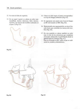 168 Estudio gnatológico
12. Se retira la ficha de registros.
13. En un papel vegetal, se calcan en color rojo:
mandíbula, dientes inferiores, labio inferior,
mentón y las marcas del overbite realizadas en
el paso 2 (Fig. 8.5).
14. Calcar en color negro el punto correspondien-
te al eje de bisagra arbitrario (Fig. 8.5).
15. Se superpone este punto con el eje de bisagra
en RC del trazado en MIC (Fig. 8.6).
16. Manteniendo esta superposición, se rota el tra-
zado hasta que coincidan las marcas del over-
bite (Fig. 8.6).
17. En esta posición se calcan también en color
rojo el resto de las estructuras que completan
el trazado, incluyendo el perfil blando desde la
glabela hasta la comisura (Fig. 8.7).
Éste es el trazado en RC, sobre el que se reali-
zarán los estudios cefalométricos.
Fig. 8.5.
Fig. 8.6. Fig. 8.7.
 