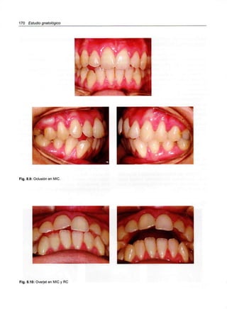 170 Estudio gnatológico
Fig. 8.9: Oclusión en MIC.
Fig. 8.10: Overjet en MIC y RC
 