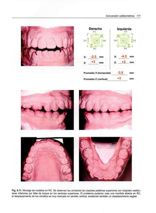 Conversión cefalométrica 171
Derecha
X: -2.5 mm
Z: +3 mm
Izquierda
X: -4,5 mm
Z: ,..,..±3 mm
Promedio X (horizontal) -3,5 mm
Promedio Z (vertical) mm
. . .
Fig. 8.11: Montaje de modelos en RC. Se observan los contactos de cúspides palatinas superiores con cúspides vestibu-
lares inferiores por falta de torque en los sectores superiores. El problema posterior crea una mordida abierta en RC,
el desplazamiento de los cóndilos es muy marcado en sentido vertical, existiendo también un desplazamiento sagital.
 