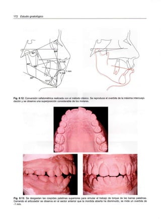 172 Estudio gnatológico
Fig. 8.12: Conversión cefalométrica realizada con el método clásico. Se reproduce el overbite de la máxima intercuspi-
dación y se observa una superposición considerable de los molares.
Fig. 8.13: Se desgastan las cúspides palatinas superiores para simular el trabajo de torque de las barras palatinas.
Cerrando el articulador se observa en el sector anterior que la mordida abierta ha disminuido, se mide un overbite de
-1 mm.
 