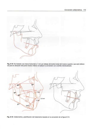 Conversión cefalométrica 173
Fig. 8.14: Se traslada una marca horizontal a 1 mm por debajo del borde incisal del incisivo superior, que será referen-
cia para la ubicación del punto incisivo inferior al realizar la conversión con overbite individualizado.
2.8 mrr
Fig. 8.15: Cefalometría y planificación del tratamiento basada en la conversión de la figura 8.14.
 