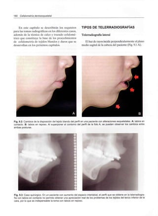 180 Cefalometría dentoesqueletal
En este capítulo se describirán los requisitos
para las tomas radiográficas en los diferentes casos,
además de la técnica de calco y trazado cefalomé-
trico que constituye la base de los procedimientos
de cefalometría de tejidos blandos y duros que se
desarrollan en los próximos capítulos.
TIPOS DE TELERRADIOGRAFÍAS
Telerradiografía lateral
El haz de rayos incide perpendicularmente al plano
medio sagital de la cabeza del paciente (Fig. 9.1 A).
Fig. 9.2: Cambios de la disposición del tejido blando del perfil en una paciente con alteraciones esqueletales. A: labios en
contacto. B: labios en reposo. Al superponer el contorno del perfil de la foto A, se pueden observar los cambios entre
ambas posturas.
Fig. 9.3: Caso quirúrgico. En un paciente con aumento del espacio interlabial, el perfil que se obtiene en la telerradiogra-
fía con labios en contacto no permite obtener una apreciación real de los problemas de los tejidos del tercio inferior de la
cara, por lo que es indispensable la toma con labios en reposo.
 