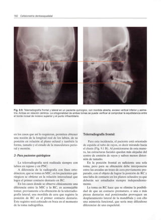 182 Cefalometría dentoesqueletal
Fig. 9.5: Telerradiografía frontal y lateral en un paciente quirúrgico, con mordida abierta, exceso vertical inferior y asime-
tría. Ambas en relación céntrica. La ortogonalidad de ambas tomas se puede verificar al comprobar la equidistancia entre
el borde incisal de incisivo superior y el punto infraorbitario.
en los casos que así lo requieran, permiten obtener
una noción de la longitud real de los labios, de su
posición en relación al plano oclusal y también la
forma, tamaño y el estado de la musculatura perio-
ral y mentón.
2- Para pacientes quirúrgicos
La telerradiografía será realizada siempre con
labios en reposo y en PNC.
A diferencia de la radiografía con fines orto-
dóncicos, que se toma en MIC, en los pacientes qui-
rúrgicos se obtiene en la relación interoclusal que
logra el primer contacto dentario en RC.
En los casos donde se observe clínicamente una
diferencia entre la MIC y la RC, es aconsejable
tomar, previamente a la obtención de la telerradio-
grafía lateral, una mordida de cera que registre la
posición de RC en el primer contacto dentario.
Este registro será colocado en boca en el momento
de la toma radiográfica.
Telerradiografía frontal:
Para esta incidencia,el paciente está orientado
de espalda al tubo de rayos, es decir mirando hacia
el chasis (Fig. 9.1 B). Al posicionarse de esta mane-
ra, las estructuras faciales quedan más alejadas del
centro de emisión de rayos y sufren menos distor-
sión de tamaño.
En la posición frontal es suficiente una sola
toma, pero para su obtención debe interponerse
entre las arcadas un trozo de cera previamente pre-
parado, con el objeto de lograr la posición de RC y
una falta de contacto en los planos oclusales ya que
deberán ser estudiados siempre independiente-
mente.
La toma en RC hace que se elimine la posibili-
dad de que un contacto prematuro, o una o más
piezas dentarias mal posicionadas provoquen un
desplazamiento lateral de la mandíbula y con ello
una asimetría funcional, que sería muy dificultoso
diferenciar de una esqueletal.
 
