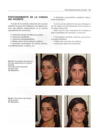Telerradiografía (lateral y frontal) 183
POSICIONAMIENTO DE LA CABEZA
DEL PACIENTE
A pesar de la correcta colocación del paciente
mediante la ayuda del cefalostato, hay algunos fac-
tores que influyen negativamente en la correcta
superposición de estructuras:
• Asimetrías faciales de diferentes grados
• Asimetría mandibular
• Asimetría maxilomandibular
• Distinta altura de los conductos auditivos
• Anomalías morfológicas de distinta naturale-
za (malformaciones, traumas, etc.)
• Asimetrías craneofaciales completas (micro-
somía hemifacial)
A su vez, en las asimetrías hay que distinguir si
son de origen vertical (alteración de los niveles) o
de origen transversal
Otras veces la mala orientación de la cabeza se
debe a problemas del operador, en casos de:
• Un paciente inestable, temeroso, que presen-
ta mucha movilidad
• Niños con trastornos de conducta
• Incorrecto ajuste del cefalostato
Fig. 9.6: Una cabeza mal posiciona-
da causa distorsiones en la telerra-
diografía.
Giro sobre el eje transversal:
A. Eje de giro.
B. Malposición.
Fig. 9.7: Giro sobre el eje vertical:
A. Eje de giro.
B. Malposición.
 