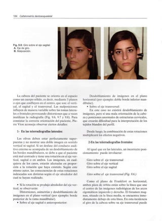 184 Cefalometría dentoesqueletal
Fig. 9.8: Giro sobre el eje sagital:
A. Eje de giro.
B. Malposición.
La cabeza del paciente se orienta en el espacio
como un cuerpo sólido, es decir, mediante 3 planos
o ejes que confluyen en el centro, que son: el verti-
cal, el sagital y el transversal. Las malposiciones
influyen de manera variable sobre las tomas latera-
les o frontales provocando distorsiones que a veces
inutilizan la radiografía (Fig. 9.6, 9.7 y 9.8). Para
constatar la correcta orientación del paciente, Fie-
rre Vion aconseja observar ciertos detalles:
1- En las telerradiografías laterales:
Las olivas deben estar perfectamente super-
puestas y no mostrar una doble imagen en sentido
vertical ni sagital. Si un desfase del conducto audi-
tivo externo se acompaña de un desdoblamiento de
los bordes mandibulares, se debe a que el paciente
está mal centrado y tiene una rotación en el eje ver-
tical, sagital o en ambos. Las imágenes, en cual-
quiera de los casos, estarán afectadas en propor-
ción a la rotación que haya existido. Según este
mismo autor, las consecuencias de estas rotaciones
indeseadas son distintas según el eje alrededor del
cual se hayan realizado.
• Sila rotación se produjo alrededor del eje ver-
tical, se observarán:
Distorsiones, asimetrías y desdoblamiento de
imágenes en el plano vertical (por ejemplo: borde
posterior de la rama mandibular).
• Sobre el eje sagital o anteroposterior:
Desdoblamiento de imágenes en el plano
horizontal (por ejemplo: doble borde inferior man-
dibular).
• Sobre el eje transversal:
En este caso no existirá desdoblamiento de
imágenes, pero sí una mala orientación de la cabe-
za y posiciones anormales de estructuras cervicales,
que crearán dificultad para la interpretación de los
tejidos blandos del perfil.
Desde luego, la combinación de estas rotaciones
multiplicará los efectos negativos.
2-En las telerradiografías frontales:
Al igual que en las laterales, un incorrecto posi-
cionamiento puede involucrar:
Giro sobre el eje transversal
Giro sobre el eje vertical
Giro sobre el eje sagital
Giro sobre el eje transversal (Fig. 9.6.)
Como el plano de Frankfort es horizontal,
ambos pisos de órbita están sobre la línea que une
el centro de las imágenes radiológicas de los arcos
cigomáticos izquierdo y derecho. El foramen mag-
nun, situado en la línea media, se encuentra inme-
diatamente debajo de esta línea. En esta incidencia
el giro de la cabeza sobre su eje transversal puede
 