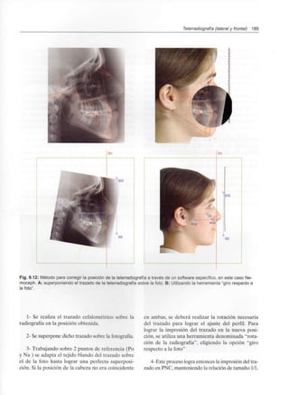 Telerradiografía (lateral y frontal) 189
Fig. 9.12: Método para corregir la posición de la telerradiografía a través de un software específico, en este caso Ne-
moceph. A: superponiendo el trazado de la telerradiografía sobre la foto. B: Utilizando la herramienta "giro respecto a
la foto".
1- Se realiza el trazado cefalométrico sobre la
radiografía en la posición obtenida.
2- Se superpone dicho trazado sobre la fotografía.
3- Trabajando sobre 2 puntos de referencia (Po
y Na ) se adapta el tejido blando del trazado sobre
el de la foto hasta lograr una perfecta superposi-
ción. Si la posición de la cabeza no era coincidente
en ambas, se deberá realizar la rotación necesaria
del trazado para lograr el ajuste del perfil. Para
lograr la impresión del trazado en la nueva posi-
ción, se utiliza una herramienta denominada "rota-
ción de la radiografía", eligiendo la opción "giro
respecto a la foto"
4- Este proceso logra entonces la impresión del tra-
zado en PNC, manteniendo la relación de tamaño 1/1.
 