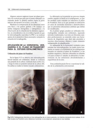 190 Cefalometría dentoesqueletal
Algunos autores sugieren trazar un plano para-
lelo a la vertical que pase por el punto subnasal y se
extienda desde la glabela cutánea hasta la parte
inferior del mentón en la foto y en la Rx.
Mediante la comparación de las distancias entre
esta línea y los puntos glabela y Po cutáneo en
ambas imágenes (fotográfica y radiográfica) y la
observación de la relación de los distintos segmen-
tos, su coincidencia o no, se evalúa el grado en que
la telerradiografía reproduce la PNC y se realizan
ajustes de la posición si fuera necesario, variando la
rotación de la radiografía.
APLICACIÓN DE LA HORIZONTAL VER-
DADERA O EL PLANO DE FRANKFORT
PARA EL ESTUDIO CEFALOMÉTRICO
Utilización del plano de Frankfort
En la figura 9.13 se observa una telerradiografía
lateral tomada con cefalostato, donde se evidencia
una posición de la cabeza inclinada hacia arriba (A),
y luego la toma en posición natural de la cabeza (B).
En ambas se realizó el mismo trazado cefalométrico.
La diferencia en la posición no provoca ningún
cambio angular ni lineal en el cefalograma, ya que
las medidas están tomadas en referencia al plano
de Frankfort. Esto es lo que permite su utilización
en casos de anomalías dentarias o dentolveolares
que no presenten alteraciones estéticas que deban
ser modificadas.
En el primer grupo, pueden ser utilizadas tele-
rradiografías tomadas con cefalostato, siguiendo
métodos tradicionales. Las teles así obtenidas cum-
plen perfectamente su cometido como una herra-
mienta de diagnóstico que dará más precisión a
nuestras observaciones clínicas y como elemento
indispensable de planificación.
La utilización de la horizontal verdadera para
orientar las telerradiografías, ha traído cierta con-
fusión en cuanto a la fiabilidad de loscefalogramas
trazados en relación al plano de Frankfort y a las
medidas angulares y lineales obtenidas en relación
a él para evaluar el tamaño, la ubicación y la inte-
rrelación de las estructuras alveolodentarias y
esqueléticas de la cara.
Esta confusión puede llevar a cuestionar la vali-
dez de la cefalometría convencional.
Fig. 9.13: Cefalogramas obtenidos en dos radiografías de un mismo paciente, con distinta orientación de la cabeza. Al uti-
lizar el plano de Frankfort como referencia horizontal, no se observan variaciones en las medidas.
 
