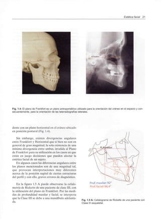 Estética facial 21
Fig. 1.4: El plano de Frankfort es un plano antropométrico utilizado para la orientación del cráneo en el espacio y con-
secuentemente, para la orientación de las telerradiografías laterales.
dente con un plano horizontal en el cráneo ubicado
en posición postural (Fig. 1.4).
Sin embargo, existen divergencias angulares
entre Frankfort y Horizontal que si bien no son en
general de gran magnitud, la sola existencia de una
mínima divergencia entre ambas, invalida al Plano
de Frankfort para su utilización en los casos en que
están en juego decisiones que pueden afectar la
estética facial de un sujeto.
En algunos casos las diferencias angulares entre
los planos mencionados son de una magnitud tal,
que provocan interpretaciones muy diferentes
acerca de la posición sagital de ciertas estructuras
del perfil y con ello, graves errores de diagnóstico.
En la figura 1.5 A puede observarse la cefalo-
metría de Ricketts de una paciente de clase III, con
la utilización del plano de Frankfort. Por las medi-
das de profundidad maxilar y facial, se interpreta
que la Clase III se debe a una mandíbula adelanta-
da.
O
Prof. maxilar:92
Prof.facial: 96,4'
Fig. 1.5 A: Cefalograma de Ricketts de una paciente con
Clase III esqueletal.
 