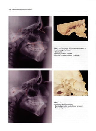 194 Cefalometría dentoesqueletal
Fig. 9.16:Estructuras del cráneo y su imagen en
la telerradiografíalateral.
• Silla turca
• Frontal y huesos nasales
• Maxilar superior y dientes superiores
Fig. 9.17:
• Conducto auditivo externo.
• Cavidad glenoidea y cóndilo del temporal.
• Fosa ptérigo-maxilar.
 