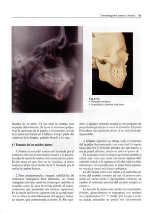 Telerradiografía (lateral y frontal) 195
I
Fig. 9.18:
• Reborde orbitario.
• Mandíbula y dientes inferiores.
blandos de la nariz. En ese caso se corrige esta
pequeña deformación. Se traza el contorno palpe-
bral, la curvatura de la pupila, y el contorno del ala
de la nariz (en forma de S itálica). Luego, parte del
contorno de la lengua, paladar blando y faringe.
b) Trazado de los tejidos duros:
1.Nasion: la zona del nasion está formada por el
contorno externo de los huesos nasales y el frontal.
Se calca la unión de ambos en la sutura frontonasal.
En los casos en que ésta no se visualiza, el punto
nasion se ubica en el vértice de la V formada por la
unión de ambos huesos.
2.Fosa pterigomaxilar: imagen radiolúcida de
contornos radiopacos bien definidos, de forma
triangular con base superior, forma que también se
describe como de gota invertida debido al redon-
deamiento que presentan sus vértices superiores.
En la unión del borde superior con la pared poste-
rior se ubica la desembocadura del agujero redon-
do mayor, que corresponde al punto Pt. En reali-
dad, el agujero redondo mayor es un conducto de
pequeña longitud que a veces se visualiza.El punto
Pt se ubica en la posición de las 11hs. en la fosa pte-
rigomaxilar.
3.Maxilar superior: se dibuja todo el contorno
del maxilar determinando con exactitud la espina
nasal anterior y el borde anterior de este hueso, o
sea la pared alveolar, donde se ubica el punto A.
Es necesario tener la mayor precisión posible al
calcar esta zona que suele presentar algunas difi-
cultades debido a la superposición del tejido celular
subcutáneo de la mejilla que, al tener buen espesor,
se visualiza como una franja radiopaca.
La diferencia entre este tejido y el contorno an-
terior del maxilar consiste en que el primero pre-
senta un borde recto o ligeramente convexo, en
cambio el contorno anterior del maxilar siempre es
cóncavo.
La zona de la espina nasal posterior en pacientes
jóvenes, generalmente se superpone con molares
no erupcionados (2.°, 3er molar) por lo que a veces
su exacta ubicación no puede ser determinada.
 