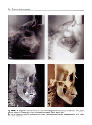196 Cefalometría dentoesqueletal
B
Fig. 9.19 A y B: Imágenes que se obtienen al procesar la telerradiografía lateral de cabeza con diferentes filtros, permi-
tiendo la visualización de los tejidos duros y blandos con diferentes efectos (Nemoceph).
C y D: A partir de una tomografía helicoidal se reconstruyen imágenes que permiten una clara visualización de las estruc-
turas óseas craneales.
 