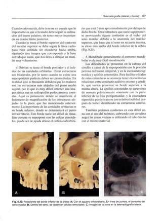 Telerradiografía (lateral y frontal) 197
Cuando esto suceda, debe tenerse en cuenta que lo
importante es que el trazado debe seguir la inclina-
ción del hueso palatino, sin tener mayor importan-
cia su exacto límite posterior.
Cuando se traza el borde superior del contorno
del maxilar superior se debe seguir la línea radio-
paca bien definida sin excederse hacia arriba,
siguiendo una imagen que corresponde a la base
del tabique nasal, que nos lleva a dibujar un maxi-
lar muy voluminoso.
4. Órbitas: se traza el borde posterior y el infe-
rior de las cavidades orbitarias . Estas estructuras
son bilaterales, por lo tanto cuando no existe una
superposición perfecta deben ser promediadas. En
realidad esto es frecuente debido a que los malares
son las estructuras más alejadas del plano medio
sagital, por lo que es muy difícil obtener una ima-
gen única aun en radiografías perfectamente toma-
das. Aquí es justamente donde se manifiesta el
fenómeno de magnificación de las estructuras ale-
jadas de la placa, que fue mencionado anterior-
mente. Lo importante de las cavidades orbitarias es
su borde inferior, donde se determinará el punto
infraorbitario. Este borde suele ser difícil de visua-
lizar porque se superpone con las celdas etmoida-
les; puede ser de ayuda ubicar el orificio suborbita-
rio que está 3 mm aproximadamente por debajo de
dicho borde. Otra estructura que suele superponer-
se provocando alguna confusión es el techo del
seno maxilar debido a la anatomía del maxilar
superior, que hace que el seno en su parte interna,
se eleve más arriba del borde inferior de la órbita
(Fig. 9.20).
5. Mandíbula: generalmente el contorno mandi-
bular es de muy fácil visualización.
Las dificultades se presentan en la cabeza del
cóndilo a causa de la superposición con la porción
petrosa del hueso temporal, y en la escotadura sig-
moidea y apófisis coronoides. Para facilitar el calco
de estas estructuras se aconseja tener en cuenta las
relaciones entre conducto auditivo externo y cóndi-
lo, que suelen presentar su borde superior a la
misma altura. La apófisis coronoides se superpone
de manera prácticamente constante con la parte
inferior de la fosa pterigomaxilar, y la escotadura
sigmoidea puede trazarse con relativa facilidad des-
pués de haber identificado las estructuras anterio-
res.
También podemos ayudarnos en esta difícil zo-
na con el uso del reóstato, cubriendo con cartulina
negra las zonas vecinas o utilizando el tubo hecho
con el mismo material.
Fig. 9.20: Relaciones del borde inferior de la órbita: A: Con el agujero infraorbitario..En línea de puntos, el contorno del
seno maxilar B: Detrás del seno, se observan células etmoidales. C: Imagen de la zona en la telerradiografía lateral.
 