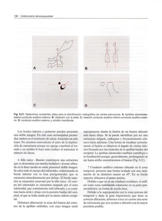 198 Cefalometría dentoesqueletal
B
Fig. 9.21: Relaciones constantes útiles para la identificación radiográfica de ciertas estructuras. A: Apófisis odontoides-
basion-conducto auditivo externo. B: Variación con la edad. C: relación conducto auditivo interno-conducto auditivo exter-
no. D: conducto auditivo externo y cóndilo mandibular.
Los bordes inferior y posterior pueden presentar
una doble imagen. En este caso aconsejamos prome-
diar ambos en el momento de calcar, haciendo un solo
trazo. No creemos conveniente el calco de la duplica-
ción de estructuras porque no agrega exactitud al tra-
zado y en cambio lo hace más confuso al aumentar el
número de líneas.
6. Silla turca - Basion: constituyen una estructura
que se determina con mucha facilidad y al estar ubica-
da en la línea media no suele presentar doble imagen.
Se calca todo el cuerpo del esfenoides, relacionando su
borde inferior con la fosa pterigomaxilar que se
encuentra inmediatamente por debajo. El borde supe-
rior se encuentra excavado por la silla turca . El cuer-
po del esfenoides se encuentra ocupado por el seno
esfenoidal, que comúnmente está tabicado, y se conti-
núa hacia atrás y abajo con la porción basilar del occi-
pital, al que se halla unido por la sutura esfeno-occipi-
tal.
Debemos diferenciar la zona del basion del extre-
mo de la apófisis estiloides, con cuya imagen suele
superponerse dando la ilusión de un basion ubicado
más hacia abajo. Se la puede identificar por ser una
estructura delgada, radiopaca y frecuentemente cón-
cava hacia adelante. Una forma de localizar correcta-
mente el basion es observar el ángulo de vértice infe-
rior formado por las corticales de la apófisis basilar del
occipital. La apófisis odontoides también contribuye a
su localización porque, generalmente, prolongando su
eje hacia arriba encontraremos el basion (Fig. 9.21).
7. Conducto auditivo extemo: ubicado en la zona
temporal, presenta una forma ovalada con una incli-
nación de su diámetro mayor en 45°. En su borde
superior ubicamos el punto porion.
Debido a que no es un conducto rectilíneo, el orifi-
cio suele verse radiolúcido solamente en su parte pos-
teroinferior, en forma de media luna.
Debido a la superposición con la zona petrosa del
temporal y dada la gran importancia que tiene su
correcta ubicación,debemos tener en cuenta una serie
de referencias que nos ayudan a ubicarlo con la mayor
precisión posible.
 