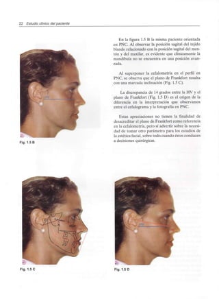 22 Estudio clínico del paciente
Fig. 1.5 B
En la figura 1.5 B la misma paciente orientada
en PNC. Al observar la posición sagital del tejido
blando relacionado con la posición sagital del men-
tón y del maxilar, es evidente que clínicamente la
mandíbula no se encuentra en una posición avan-
zada.
Al superponer la cefalometría en el perfil en
PNC, se observa que el plano de Frankfort resulta
con una marcada inclinación (Fig. 1.5 C).
La discrepancia de 14 grados entre la HV y el
plano de Frankfort (Fig. 1.5 D) es el origen de la
diferencia en la interpretación que observamos
entre el cefalograma y la fotografía en PNC.
Estas apreciaciones no tienen la finalidad de
desacreditar el plano de Frankfort como referencia
en la cefalometría, pero sí advertir sobre la necesi-
dad de tomar otro parámetro para los estudios de
la estética facial, sobre todo cuando éstos conducen
a decisiones quirúrgicas.
Fig. 1.5 C Fig. 1.5 D
 