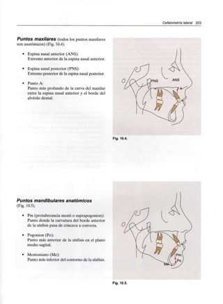 Cefalometría lateral 203
Puntos maxilarBS (todos los puntos maxilares
son anatómicos) (Fig. 10.4).
• Espina nasal anterior (ANS):
Extremo anterior de la espina nasal anterior.
• Espina nasal posterior (PNS):
Extremo posterior de la espina nasal posterior.
• Punto A:
Punto más profundo de la curva del maxilar
entre la espina nasal anterior y el borde del
alvéolo dental.
Fig. 10.4.
Puntos mandibulares anatómicos
(Fig. 10.5).
• Pm (protuberancia rnenti o suprapogonion):
Punto donde la curvatura del borde anterior
de la sínfisis pasa de cóncava a convexa.
• Pogonion (Po):
Punto más anterior de la sínfisis en el plano
medio sagital.
• Mentoniano (Me):
Punto más inferior del contorno de la sínfisis.
Fig. 10.5.
 