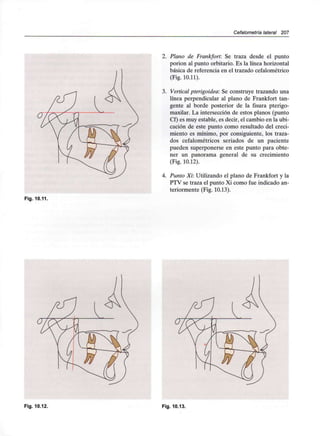 Cefalometría lateral 207
2. Plano de Frankfort: Se traza desde el punto
podón al punto orbitario. Es la línea horizontal
básica de referencia en el trazado cefalométrico
(Fig. 10.11).
3. Vertical pterlgoidea: Se construye trazando una
línea perpendicular al plano de Frankfort tan-
gente al borde posterior de la fisura pterigo-
maxilar. La intersección de estos planos (punto
Cf) es muy estable, es decir, el cambio en la ubi-
cación de este punto como resultado del creci-
miento es mínimo, por consiguiente, los traza-
dos cefalométricos seriados de un paciente
pueden superponerse en este punto para obte-
ner un panorama general de su crecimiento
(Fig. 10.12).
4. Punto Xi: Utilizando el plano de Frankfort y la
PTV se traza el punto Xi como fue indicado an-
teriormente (Fig. 10.13).
Fig. 10.11.
Fig. 10.12. Fig. 10.13.
 