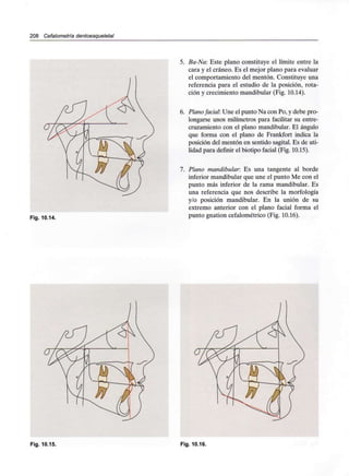 208 Cefalometría dentoesqueletal
Fig. 10.14.
5. Ba-Na: Este plano constituye el límite entre la
cara y el cráneo. Es el mejor plano para evaluar
el comportamiento del mentón. Constituye una
referencia para el estudio de la posición, rota-
ción y crecimiento mandibular (Fig. 10.14).
6. Planofacial: Une el punto Na con Po, y debe pro-
longarse unos milímetros para facilitar su entre-
cruzamiento con el plano mandibular. El ángulo
que forma con el plano de Frankfort indica la
posición del mentón en sentido sagital. Es de uti-
lidad para definir el biotipo facial (Fig. 10.15).
7. Plano mandibular. Es una tangente al borde
inferior mandibular que une el punto Me con el
punto más inferior de la rama mandibular. Es
una referencia que nos describe la morfología
y/o posición mandibular. En la unión de su
extremo anterior con el plano facial forma el
punto gnation cefalométrico (Fig. 10.16).
Fig. 10.15. Fig. 10.16.
 