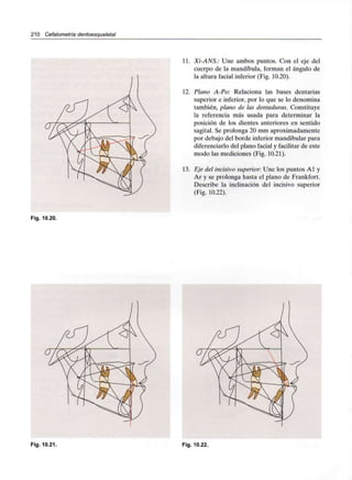 210 Cefalometría dentoesqueletal
11. Xi-ANS.: Une ambos puntos. Con el eje del
cuerpo de la mandíbula, forman el ángulo de
la altura facial inferior (Fig. 10.20).
12. Plano A-Po: Relaciona las bases dentarias
superior e inferior, por lo que se lo denomina
también, plano de las dentaduras. Constituye
la referencia más usada para determinar la
posición de los dientes anteriores en sentido
sagital. Se prolonga 20 mm aproximadamente
por debajo del borde inferior mandibular para
diferenciarlo del plano facial y facilitar de este
modo las mediciones (Fig. 10.21).
13. Eje del incisivo superior: Une los puntos Al y
Ar y se prolonga hasta el plano de Frankfort.
Describe la inclinación del incisivo superior
(Fig. 10.22).
Fig. 10.20.
Fig. 10.21. Fig. 10.22.
 