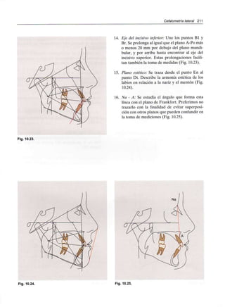 Cefalometría lateral 211
14. Eje del incisivo inferior: Une los puntos Bl y
Br. Se prolonga al igual que el plano A-Po más
o menos 20 mm por debajo del plano mandi-
bular, y por arriba hasta encontrar al eje del
incisivo superior. Estas prolongaciones facili-
tan también la toma de medidas (Fig. 10.23).
15. Plano estético: Se traza desde el punto En al
punto Dt. Describe la armonía estética de los
labios en relación a la nariz y el mentón (Fig.
10.24).
16. Na - A: Se estudia el ángulo que forma esta
línea con el plano de Frankfort. Preferimos no
trazarlo con la finalidad de evitar superposi-
ción con otros planos que pueden confundir en
la toma de mediciones (Fig. 10.25).
Fig. 10.23.
Fig. 10.24. Fig. 10.25.
 
