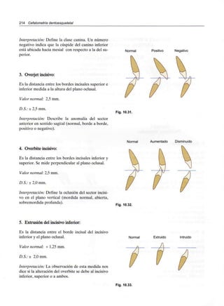 214 Cefalometría dentoesqueletal
Interpretación: Define la clase canina. Un número
negativo indica que la cúspide del canino inferior
está ubicada hacia mesial con respecto a la del su-
perior.
3. Overjet incisivo:
Es la distancia entre los bordes incisales superior e
inferior medida a la altura del plano oclusal.
Valor normal: 2,5 mm.
D.S.: ± 2,5 mm.
Interpretación: Describe la anomalía del sector
anterior en sentido sagital (normal, borde a borde,
positivo o negativo).
Normal Positivo Negativo
Fig. 10.31.
Normal Aumentado Disminuido
4. Overbite incisivo:
Es la distancia entre los bordes incisales inferior y
superior. Se mide perpendicular al plano oclusal.
Valor normal: 2,5 mm.
D.S.: ± 2,0 mm.
Interpretación: Define la oclusión del sector incisi-
vo en el plano vertical (mordida normal, abierta,
sobremordida profunda).
Fig. 10.32.
5. Extrusión del incisivo inferior:
Es la distancia entre el borde incisal del incisivo
inferior y el plano oclusal.
Valor normal: + 1,25 mm.
D.S.:± 2,0 mm.
Interpretación: La observación de esta medida nos
dice si la alteración del overbite se debe al incisivo
inferior, superior o a ambos.
Normal Extruido Intruido
Fig. 10.33.
 