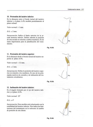 Cefalometría lateral 217
10. Protrusión del incisivo inferior:
Es la distancia entre el borde incisal del incisivo
inferior y el plano A-Po medida paralelamente al
plano oclusal.
Valor normal: +1 mm.
D.S.: ± 2 mm.
Interpretación: Indica el límite anterior de la ar-
cada dentaria inferior. Define además la posición
de esta arcada en relación a ambos maxilares. Es de
suma importancia para la planificación del trata-
miento.
11. Protrusión del incisivo superior:
Es la distancia desde el borde incisal del incisivo su-
perior al plano A-Po.
Valor normal: + 3,5 mm.
D.S.: ± 2 mm.
Interpretación: Define la posición del incisivosupe-
rior en relación a los maxilares. Es uno de los prin-
cipales motivos de consulta y de indicación del tra-
tamiento ortodóncico.
Po
Fig. 10.38.
Po
Fig. 10.39.
12. Inclinación del incisivo inferior:
Es el ángulo formado por el eje del incisivo infe-
rior y el plano A-Po.
Valor normal: 22°
D.S.: ± 4°
Interpretación: Esta medida está relacionada con la
estabilidad del incisivo inferior. Nos indica las limi-
taciones del tratamiento en lo referente al cambio
de posición de este diente
Fig. 10.40.
 