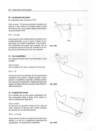 224 Cefalometría dentoesqueletal
30. Localización del porion
Es la distancia entre el porion y PTV.
Valor normal: - 39mm para pacientes normales a la
edad de 9 años. Debe ser corregido según la edad
(0,8 mm por año). Se usa signo negativo para indicar
un porion distal a PTV.
D.S.: ± 2,2 mm.
Interpretación: Esta medida indica la posición de la
cavidad glenoidea y por lo tanto el lugar de im-
plantación del cóndilo mandibular. Una localiza-
ción adelantada del porion está asociada con un
crecimiento latente de Clase III. También se lo uti-
liza para la detección precoz de esta anomalía.
PTV
Fig. 10.58.
31. Arco mandibular:
Es el ángulo formado entre el eje del cuerpo y el eje
condilar.
Valor normal:
26° a la edad de 8l/2 años. Aumenta 0,5° por año.
D.S.-: ± 4°
Interpretación: Es un indicador de las características
musculares del paciente. Ángulos grandes corres-
ponden a mandíbulas cuadradas, mordidas profun-
das y patrones braquifaciales. Ángulos de bajo valor
indican mordidas abiertas, patrones dolicofaciales y
débil musculatura.
Fig. 10.59.
32. Longitud del cuerpo:
Es la medida del eje del cuerpo mandibular (Xi-
Pm) prolongado hasta el plano A-Po. (Suele to-
marse erróneamente hasta Pm.)
Valor normal:
65 mm para un paciente normal de 8^/2 años de
edad. Aumenta 1,6 mm por año y debe corregirse
de acuerdo con la edad del paciente.
D.S.>: ± 2,7 mm.
Interpretación: Evalúa la longitud del cuerpo man-
dibular y es útil en el diagnóstico diferencial del
prognatismo o retrognatismo mandibular. Fig. 10.60.
 