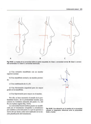 Cefalometría lateral 229
A B C
Fig 10.62: La medida de la convexidad define el patrón esqueletal. A: Clase I, convexidad normal. B: Clase II, convexi-
dad aumentada. C: Clase III, convexidad disminuida.
a) Una retrusión mandibular con un maxilar
superior normal.
b) Una mandíbula normal y un maxilar protrui-
do.
c) Una combinación de A y B.
d) Una birretrusión esqueletal pero de mayor
grado en la mandíbula.
e) Una biprotrusión pero mayor en el maxilar.
Por ello, se hace necesario el estudio de la pro-
fundidad facial y de la profundidad maxilar para
conocer la verdadera situación del punto A y del
Po en el plano sagital (Fig. 10.63).
La convexidad facial también puede ser modifi-
cada por el tratamiento ortopédico u ortodóncico
por cambios a nivel del punto A o por la apertura o
cierre del eje facial, como será explicado en la sec-
ción planificación del tratamiento.
Fig 10.63: Una alteración en la medida de la convexidad
requiere el diagnóstico diferencial entre la profundidad
facial y maxilar.
 