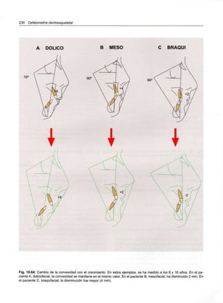 230 Cefalometría dentoesqueletal
76°
A DOLICO B MESO
90C
C BRAQUI
96°
Fig. 10.64: Cambio de la convexidad con el crecimiento. En estos ejemplos, se ha medido a los 8 y 16 años. En el pa-
ciente A, dolicofacial, la convexidad se mantiene en el mismo valor. En el paciente B, mesofacial, ha disminuido 2 mm. En
el paciente C, braquifacial, la disminución fue mayor (4 mm).
 
