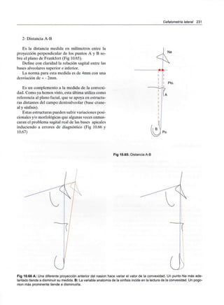 Cefalometría lateral 231
2- Distancia A-B
Es la distancia medida en milímetros entre la
proyección perpendicular de los puntos A y B so-
bre el plano de Frankfort (Fig 10.65).
Define con claridad la relación sagital entre las
bases alveolares superior e inferior.
La norma para esta medida es de 4mm con una
desviación de + - 2mm.
Es un complemento a la medida de la convexi-
dad. Como ya hemos visto, esta última utiliza como
referencia al plano facial, que se apoya en estructu-
ras distantes del campo dentoalveolar (base crane-
al y sínfisis).
Estas estructuras pueden sufrir variaciones posi-
cionales y/o morfológicas que algunas veces enmas-
caran el problema sagital real de las bases apicales
induciendo a errores de diagnóstico (Fig 10.66 y
10.67) Po
Fig 10.65: Distancia A-B
Fig 10.66 A: Una diferente proyección anterior del nasion hace variar el valor de la convexidad. Un punto Na más ade-
lantado tiende a disminuir su medida. B: La variable anatomía de la sínfisis incide en la lectura de la convexidad. Un pogo-
nion más prominente tiende a disminuirla.
 