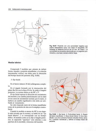 232 Cefalometría dentoesqueletal
+ 4,5 mm
Fig 10.67: Paciente con una convexidad negativa que
podría interpretarse como una Clase III esqueletal. Sin
embargo la distancia A-B es de 4,5 mm, de Clase I. La
convexidad se encuentra disminuida por un pogonion pro-
minente y una base craneal anterior larga.
Maxilar inferior:
Comprende 5 medidas que además de definir
forma, tamaño y posición mandibular y la relación
intermaxilar vertical, son útiles para la obtención
del biotipo facial del paciente (Fig. 10.68).
3- Eje facial:
Es el factor número 20 del cefalogramacomple-
to.
Es el ángulo formado por la intersección del
plano Ba-Na con la línea Pt-Gn. Se mide el ángulo
posterior. La norma clínica es de 90° ± 3°.
El eje facial expresa la dirección de crecimiento
del mentón y no cambia prácticamente con la edad
en los casos de crecimiento normal, por lo tanto, si
hubiera un cambio significativo éste debe ser atri-
buido al tratamiento.
Su valor depende tanto de la forma mandibular
como de la posición de ésta en el complejo cráneo-
facial.
Cuando la medida es menor de 90°(o sea ángu-
lo más cerrado que la norma), se habla de un "eje
facial abierto", y se corresponde con un biotipo
dólico. Al medirse como ya se dijo el ángulo poste-
rior, la expresión "apertura" está referida a una
apertura de la mordida y descenso del mentón.
Fig 10.68: 1- Eje facial. 2- Profundidad facial. 3- Ángulo
del plano mandibular. 4-Altura facial inferior. 5-Arco man-
dibular. Los cinco primeros factores estudian forma, tama-
ño y posición mandibular y definen el biotipo facial del
paciente.
 
